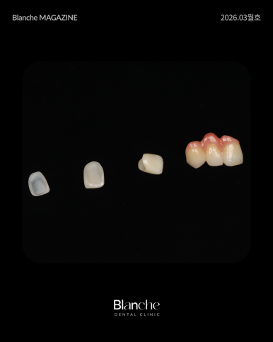 옛날에 한 라미네이트, 요즘 자꾸 신경 쓰인다면? 관련 이미지 6