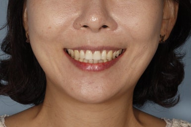 [블랑쉬치과] 치아 교정하고 난 후에 블랑쉬 가능할까요? 관련 이미지 5