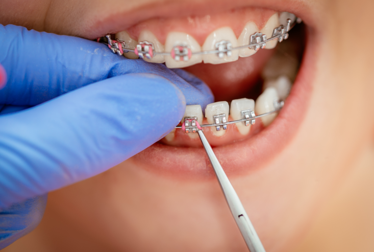 2 Factors Behind Differences in Orthodontic Costs: Something Else Matters More Than the Appliance image 2