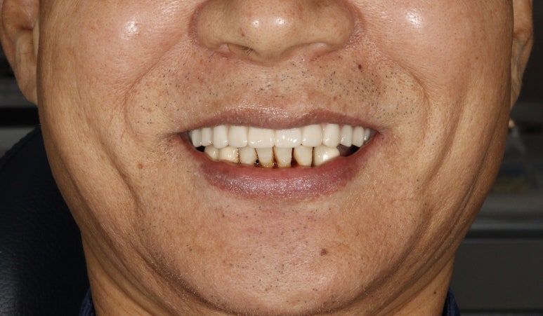 강남 풀아치 임플란트 치과, 4개로 틀니를 대체한다? 관련 이미지 13