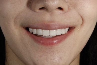 치아미백 라미네이트, 그리고 무삭제 라미네이트의 차이는? 관련 이미지 12