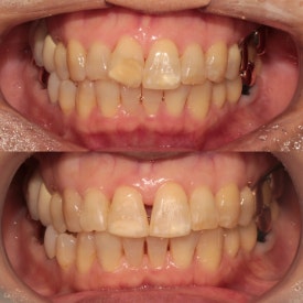 서초교정치과, 20년차 교정 전문의가 모두 대답해드립니다. <의사 작성> 관련 이미지 13