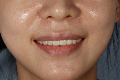 치아미백 라미네이트, 그리고 무삭제 라미네이트의 차이는? 관련 이미지 16