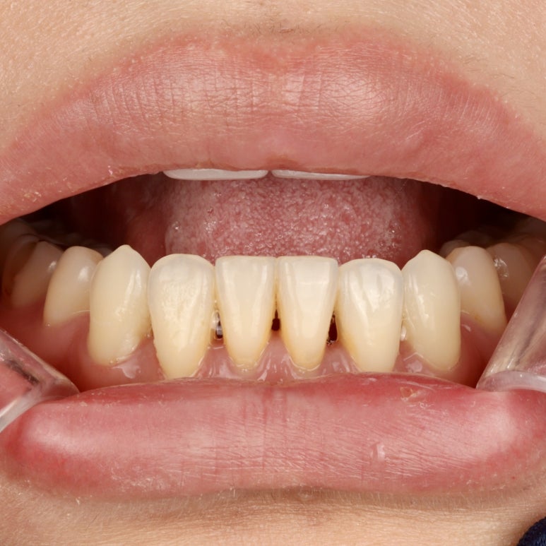 Black Triangles: Causes and Prevention to Know Before Resin Treatment image 2