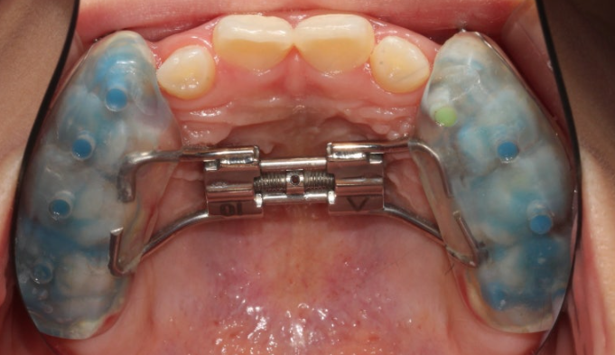 뻐드렁니 교정 2년 고생하고 후회하는 사람 vs 6개월 만에 인생 미소 찾은 사람 관련 이미지 3