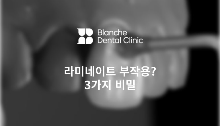 라미네이트부작용을 막는 3가지 비밀 - 대표원장 작성 관련 이미지 1