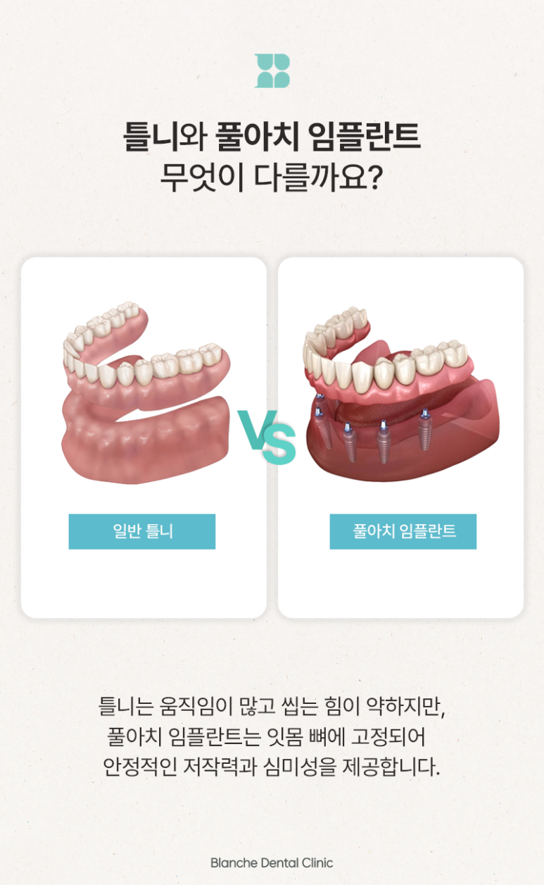 풀아치 임플란트 대상, 치료 시기와 기준을 알려드립니다 관련 이미지 3