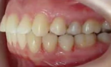 발치 없이 가능할까? 앞니 부분교정 전 반드시 체크해야 할 진단 포인트 관련 이미지 14