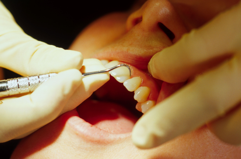 Tooth Sensitivity and “Holes” in the Gums After Scaling? Normal Reactions and Warning Signs image 5