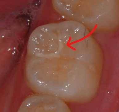 Cases Where Root Canal Treatment for Cavities Is Not Covered by National Health Insurance image 4
