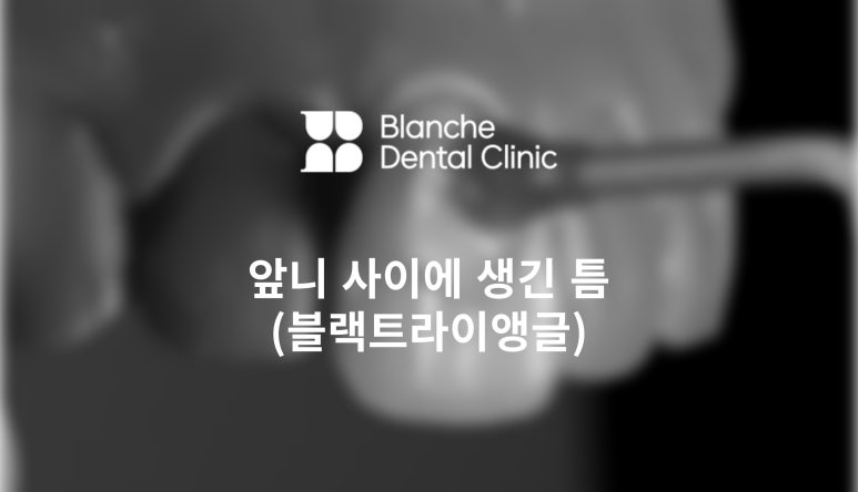 앞니 사이에 생긴 틈을 해결하는 방법 (블랙 트라이 앵글) 관련 이미지 1