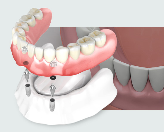 풀아치 임플란트 비용, 방법, 효과 모두 정리했습니다. 관련 이미지 5