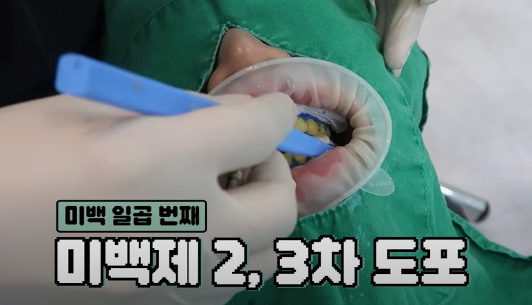 치아미백 시술,  시간과 가격 한계점까지 알려드립니다. 관련 이미지 9