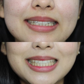 반포교정치과 고르는 3가지 기준,가격 투명 공개 관련 이미지 6