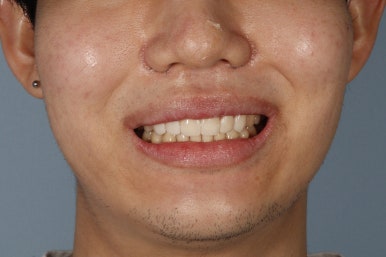 무삭제 라미네이트 비용, 이것만은 꼭 확인했어야 했어요 관련 이미지 19