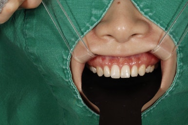 치아미백 라미네이트, 그리고 무삭제 라미네이트의 차이는? 관련 이미지 18