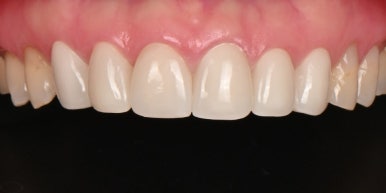 무삭제 라미네이트 가격 비교? 이 글로 정리해드립니다. 관련 이미지 17