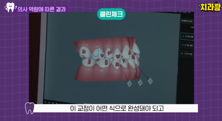 투명교정 vs 메탈교정 비용 비교, 뭐가 더 이득일까? 관련 이미지 7