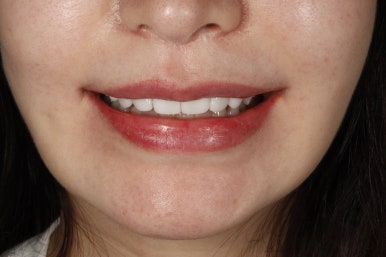 앞니 라미네이트 가격, 자연치아 보존이 우선이라면 관련 이미지 15