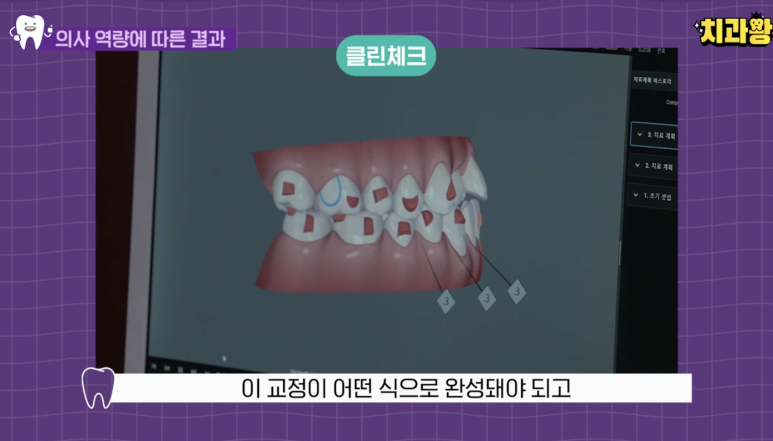 신사동 교정치과 인비절라인 가격 과정 알려드림 관련 이미지 10