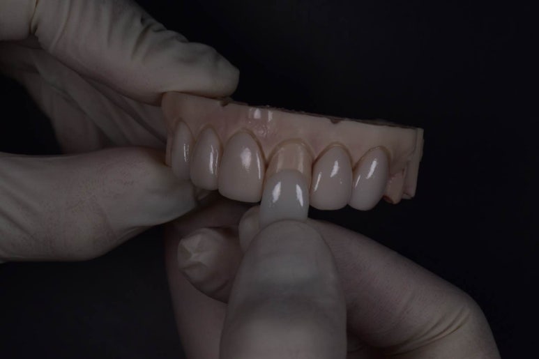 치아무삭제라미네이트 절대 쉽지 않은 3가지 이유 관련 이미지 2