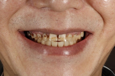 치아미백 시술 효과, 과정만큼 중요한 관리 방법 관련 이미지 16