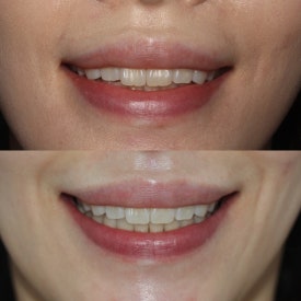 반포교정치과 고르는 3가지 기준,가격 투명 공개 관련 이미지 8