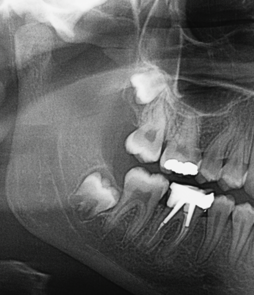 Impacted, Horizontally Positioned Wisdom Tooth Extraction: 3 Cases Where Extraction May Not Be Necessary image 2