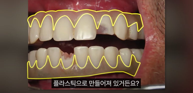 풀아치 임플란트 치과? 임플란트 결정 전 꼭 읽어보세요. 관련 이미지 12