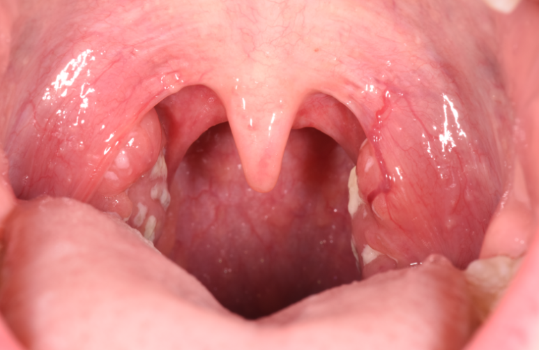 You Brush Thoroughly, but Still Have Bad Breath? 4 Real Causes Your Toothbrush Can’t Reach image 4
