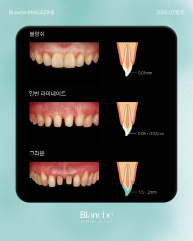 유독 작은 옆니(왜소치), 깎지 않고 예뻐질 수 있을까? 관련 이미지 12