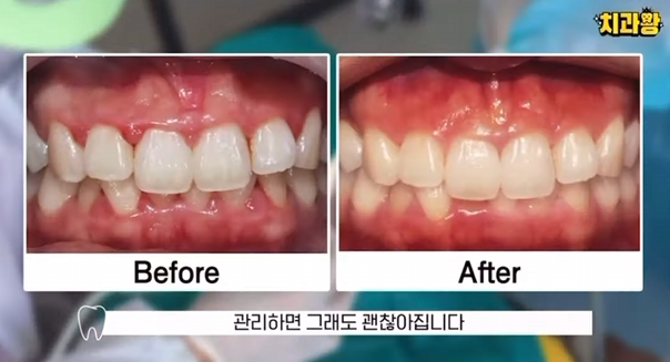 잇몸 부었을 때, 절대로 방치하면 안되는 증상 3가지 관련 이미지 4