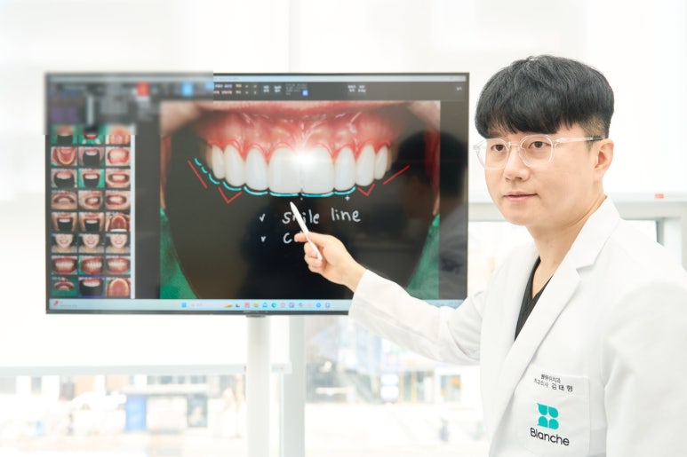 Check No-Prep Veneer Side Effects in Advance image 2