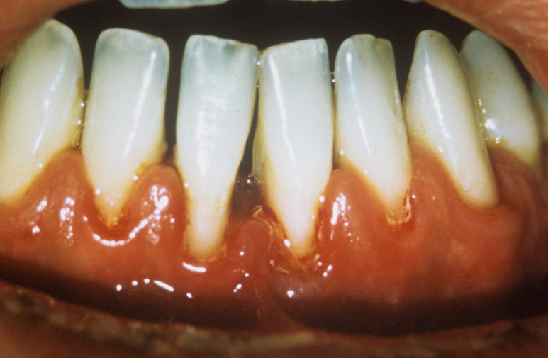 풍치 치료 초기&middot;중기&middot;말기, 단계별 치료비가 10배 차이 나는 이유 관련 이미지 3
