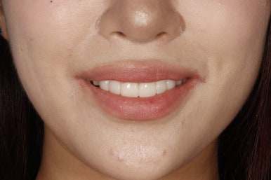 [블랑쉬치과] 치아 교정하고 난 후에 블랑쉬 가능할까요? 관련 이미지 3