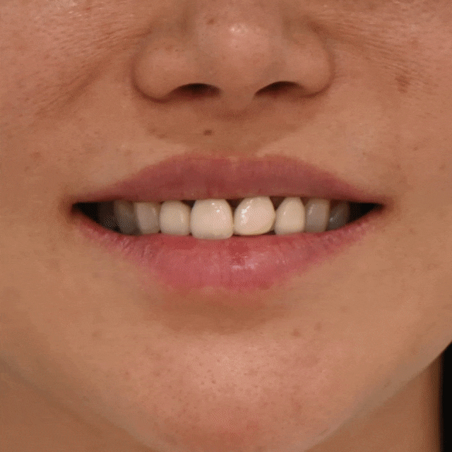 무삭제 라미네이트 vs 블랑쉬, 대표원장이 직접 알려주는 차이점 관련 이미지 7