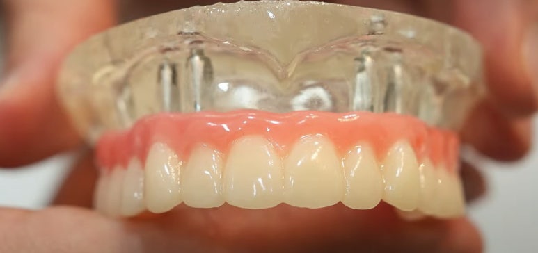 풀아치 임플란트 치과? 임플란트 결정 전 꼭 읽어보세요. 관련 이미지 2