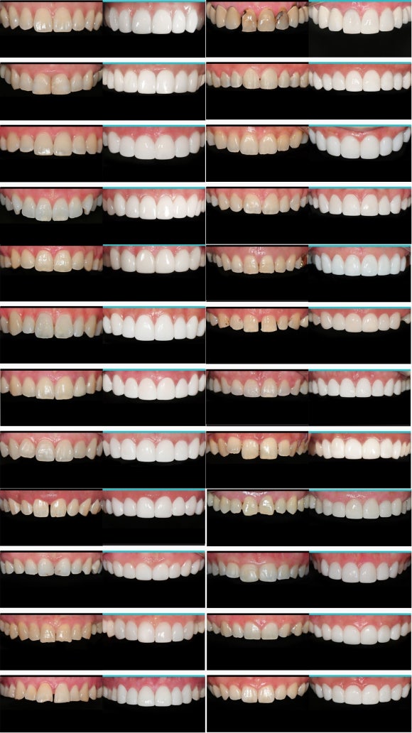 치아미백 시술? 블랑쉬? 어떤 것이 좋을지 고민된다면 관련 이미지 14