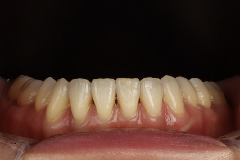 Same-Day Veneers in Korea : Cost, Process & Tips - Blanche Dental Clinic 관련 이미지 5