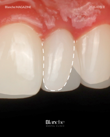 유독 작은 옆니(왜소치), 깎지 않고 예뻐질 수 있을까? 관련 이미지 8