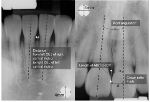 Front Tooth Partial Orthodontic Cost, image 6
