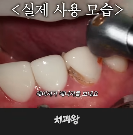 역삼동 앞니 라미네이트 재시술 붙이는 것보다 중요한 1가지 앞니마법사가 알려드림 관련 이미지 9