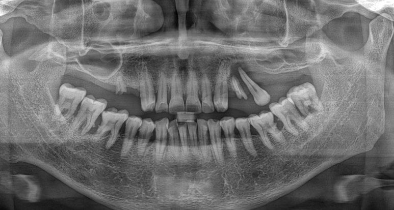Can a Molar Cavity Be Treated with an Inlay, or Does It Need a Crown? — How Chewing Forces Determine the Choice image 5