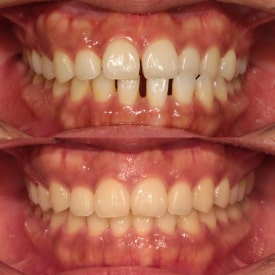 서초교정치과, 20년차 교정 전문의가 모두 대답해드립니다. <의사 작성> 관련 이미지 10