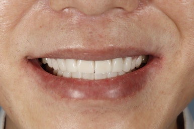 치아미백 시술 효과, 과정만큼 중요한 관리 방법 관련 이미지 17