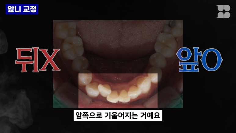 발치 없이 가능할까? 앞니 부분교정 전 반드시 체크해야 할 진단 포인트 관련 이미지 5