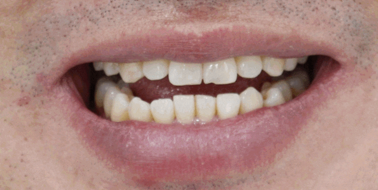 치아미백 시술,  시간과 가격 한계점까지 알려드립니다. 관련 이미지 1