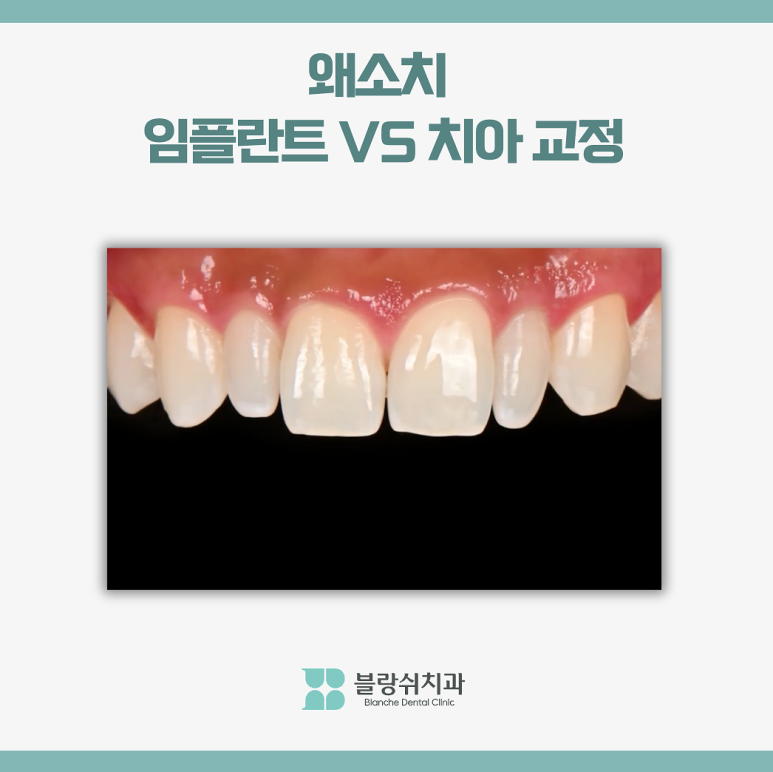 왜소치 치아교정 임플란트 고민이라면 관련 이미지 11