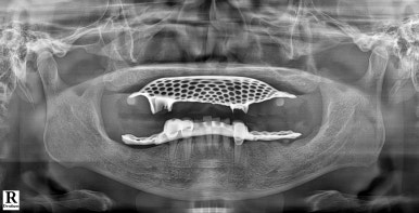 강남 풀아치 임플란트 치과, 4개로 틀니를 대체한다? 관련 이미지 7