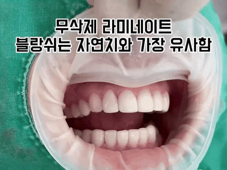 블랑쉬 라미네이트, 가격 속에 숨겨진 3가지 비밀 관련 이미지 1